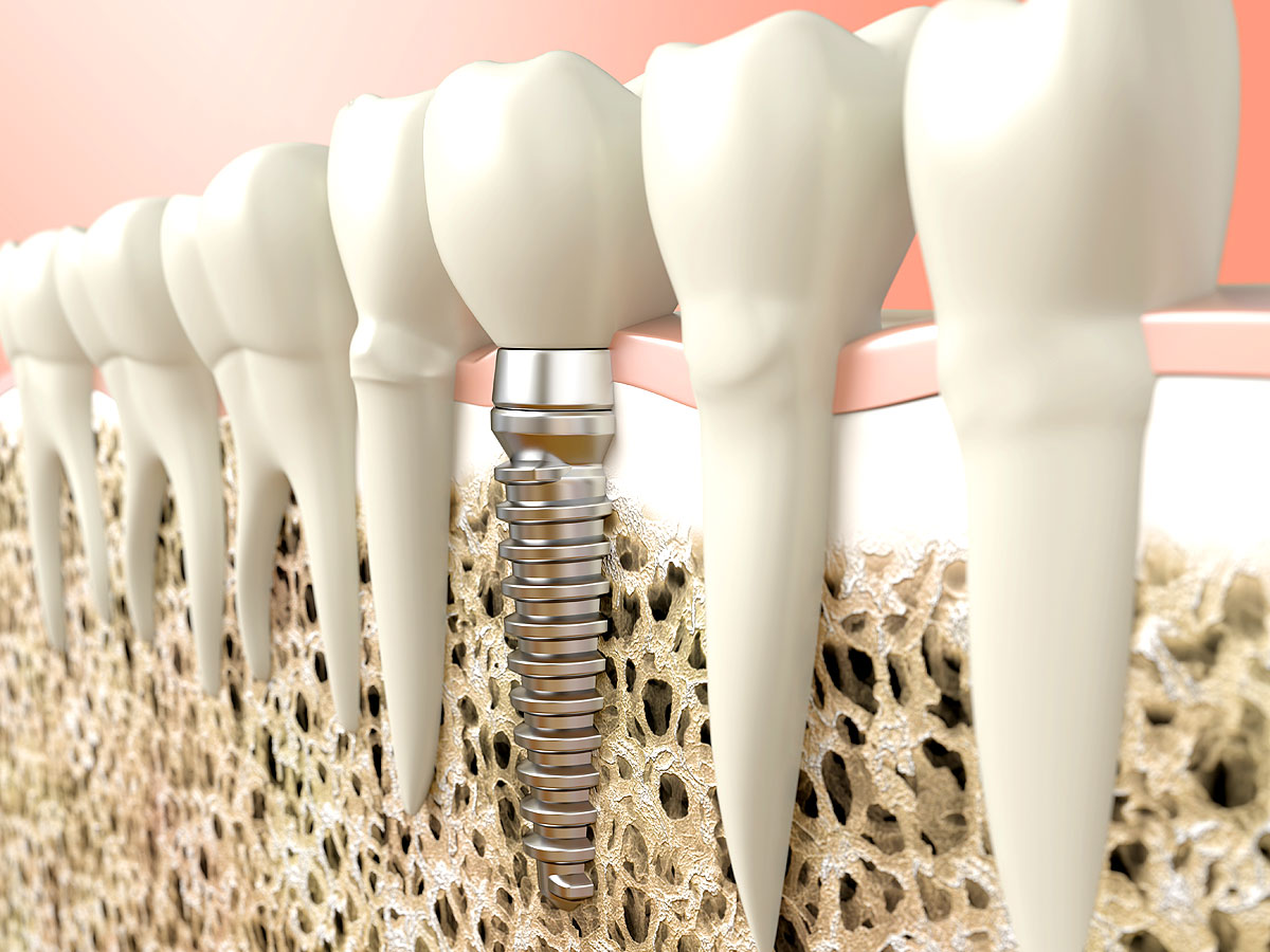 Zahnimplantate werden wie echte Zähne im Kiefer verankert